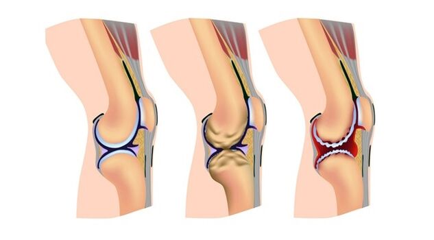 etapas da artrose da articulación do xeonllo