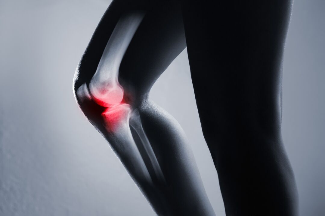inflamación da articulación do xeonllo con artrose
