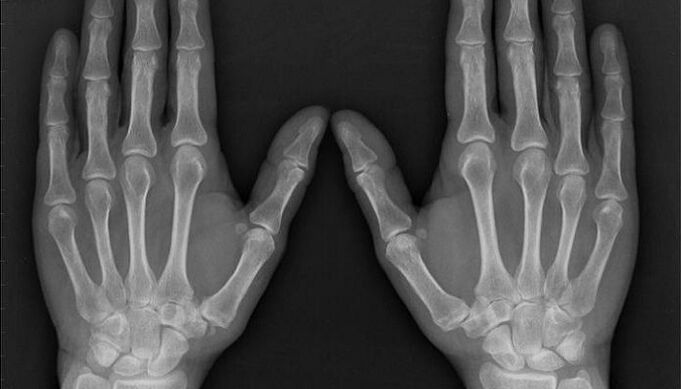radiografía para o diagnóstico de artrite e artrose