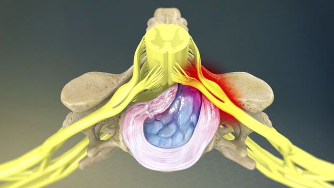 Unha das causas da dor nas costas é unha hernia discal. 