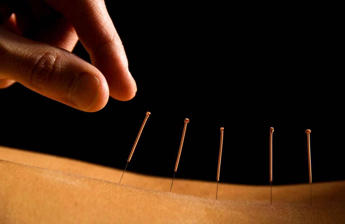 acupuntura para a dor nas costas