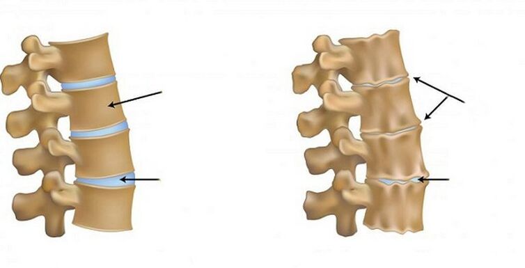 Síndrome isquémico para osteocondrose
