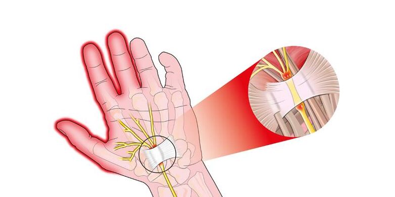 Dor nas articulacións dos dedos con risartrose