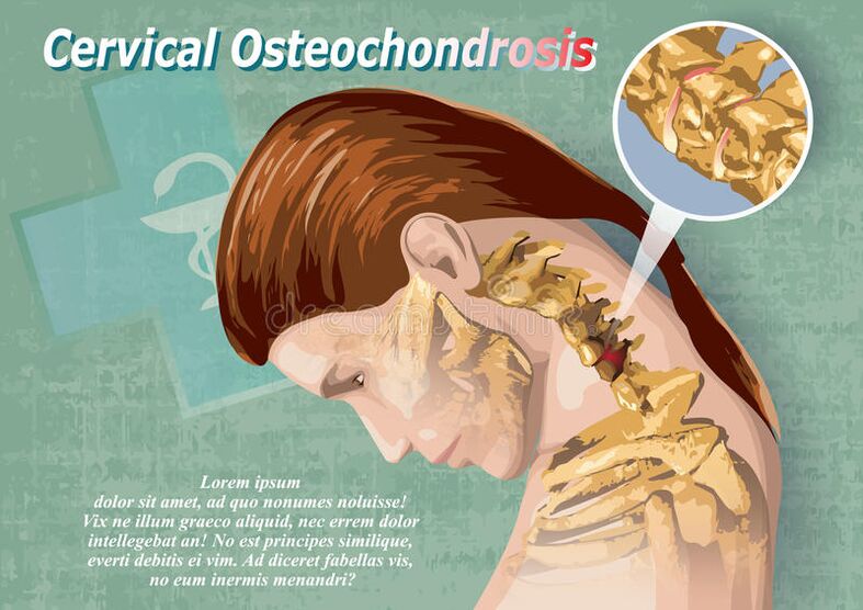 A osteocondrose cervical é unha enfermidade do tecido cartilaxe